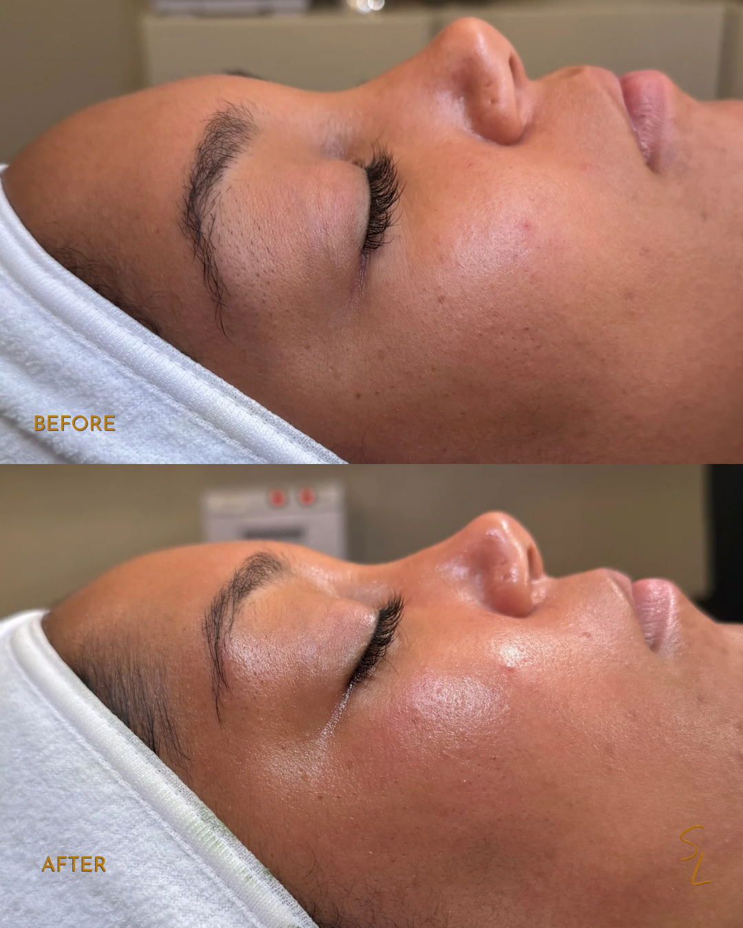 Side-by-side comparison of a woman's face before and after a facial treatment. The "before" image shows the skin with visible pores and uneven texture, while the "after" image shows smoother, more radiant skin with reduced pore visibility.