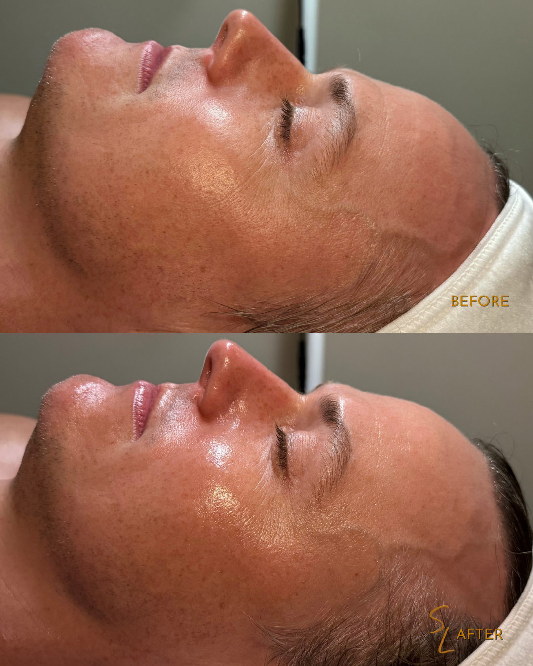 Comparison of a man's face before and after skincare treatment, showing improved skin texture and tone.