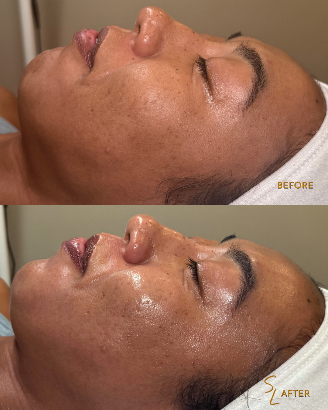 Side-by-side comparison of a woman's face before and after a skincare treatment, showing improved skin texture, reduced pigmentation, and added shine after the treatment.