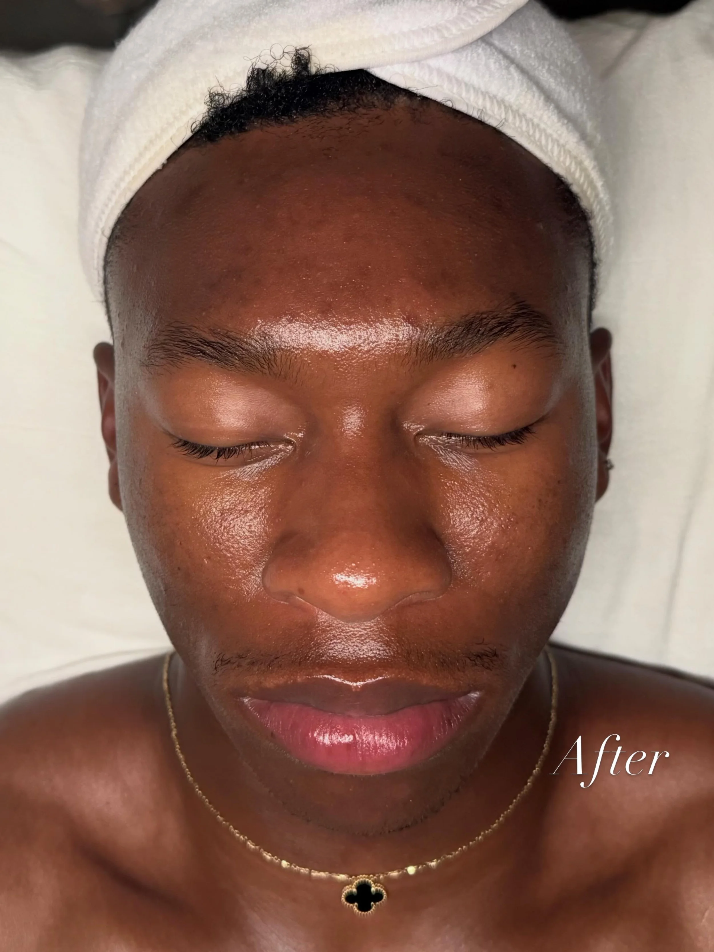 Reduced congestion and inflammation. Increased hydration🪄
.
Service: Sculpt + Lift (60 Min)
.
Results: Sculpt- up to 2 weeks, Glow- up to a month
.
Investment: $180
.
.
.
#lymphaticfacial #losangelesfacial #losangelesskincare #skincare #facial