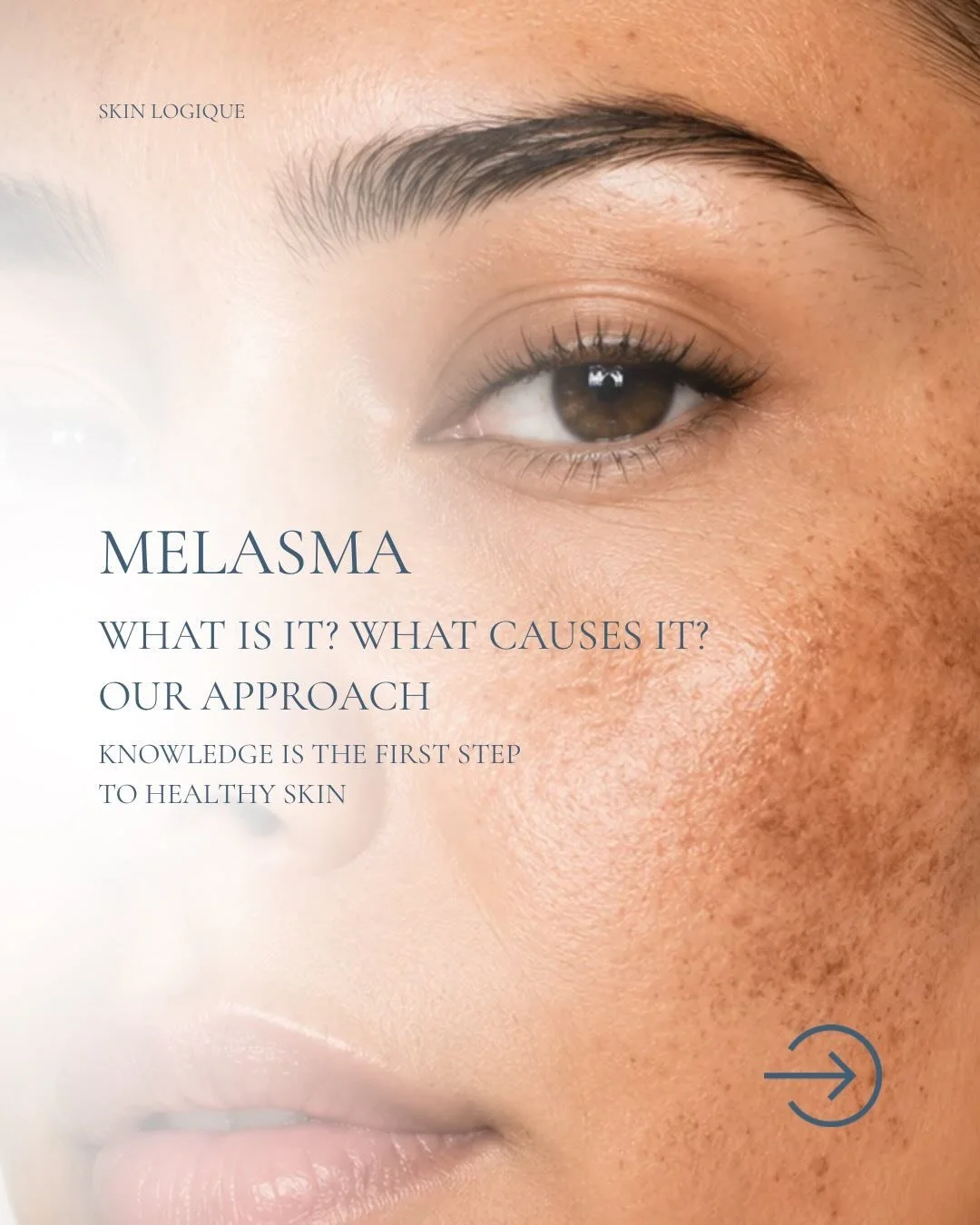 Melasma can be one of the trickiest skin concerns to treat. Here are some pointers to help you understand your options when it comes to managing your melasma✨
.
.
.
#melasmatreatment #losangelesfacial #darkspotsolution #skincare #losangelesestheticia