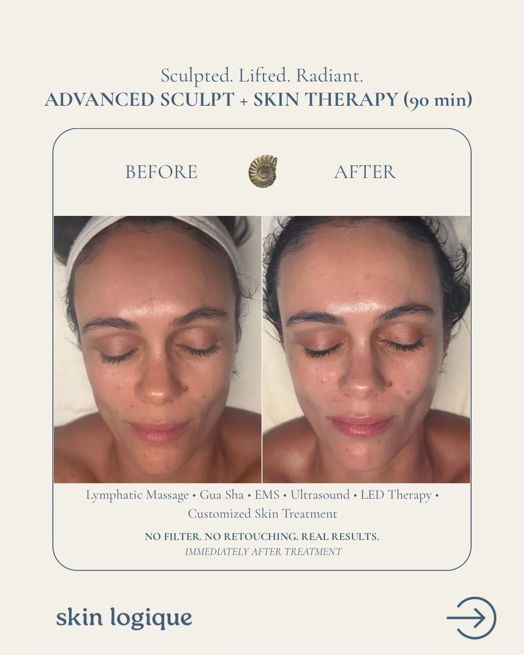 Advanced Sculpt + Skin Therapy (90 min) RESULTS✨
.
Service Area: Face + Neck + D&eacute;collet&eacute; 
Time: 90 mins
What&rsquo;s included: double cleanse, skin analysis, facial acupressure, lymphatic facial massage, gua sha, facial muscle stimulati