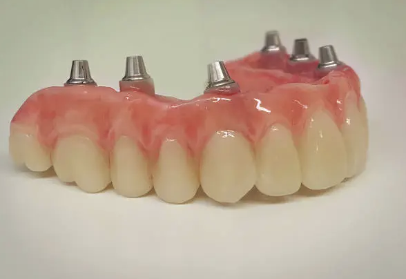 All-on-4 (Ti-Bar + Acrylic)