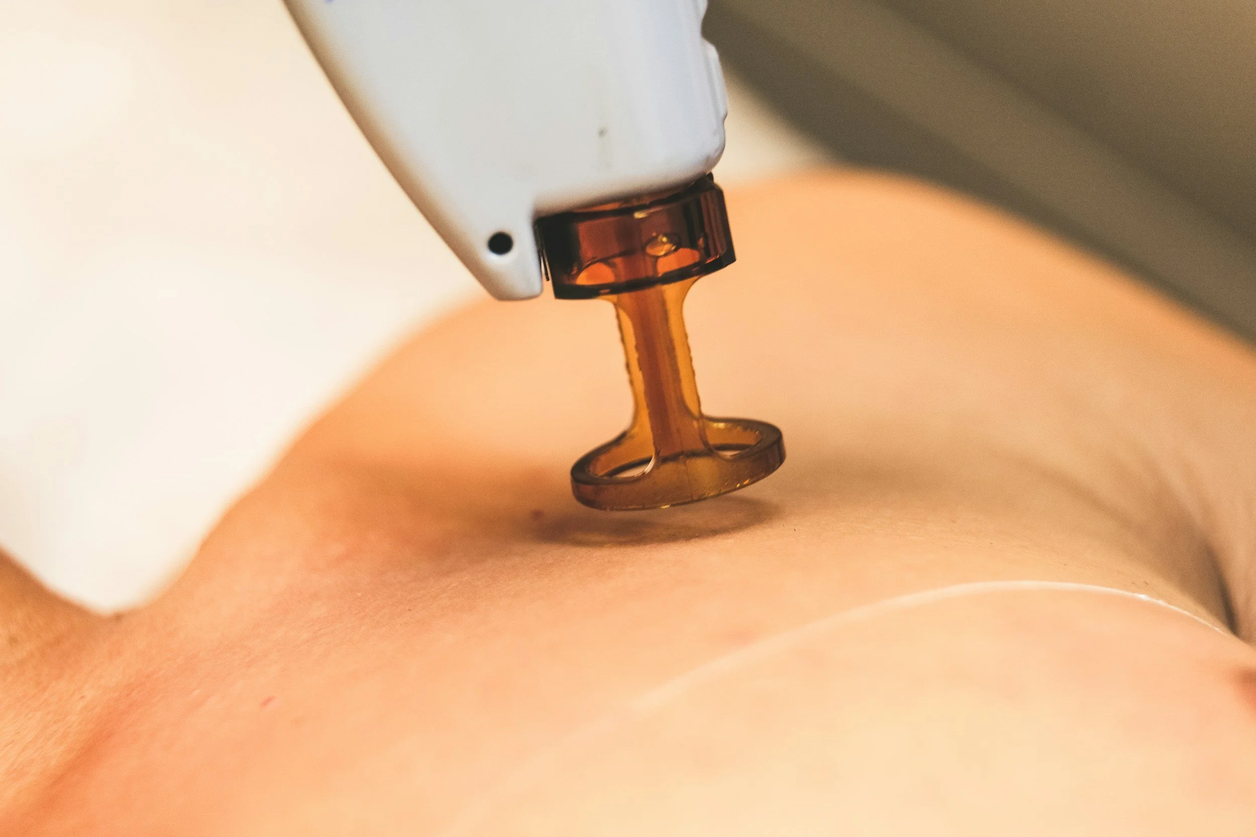 Close-up of a medical device or tool with a transparent orange part, positioned over skin.