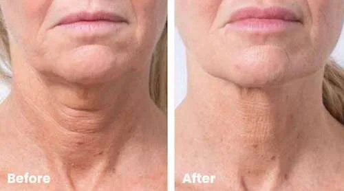 Profhilo before and after for the neck