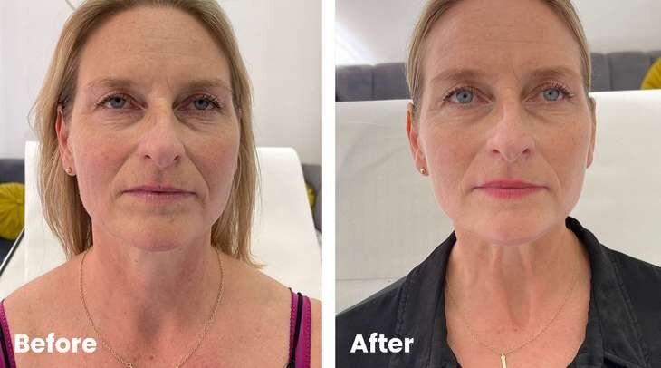 Profhilo before and after for the face