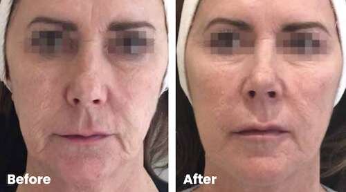 Profhilo before and after for the cheeks