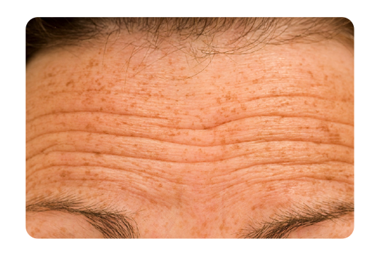 Forehead Lines.png