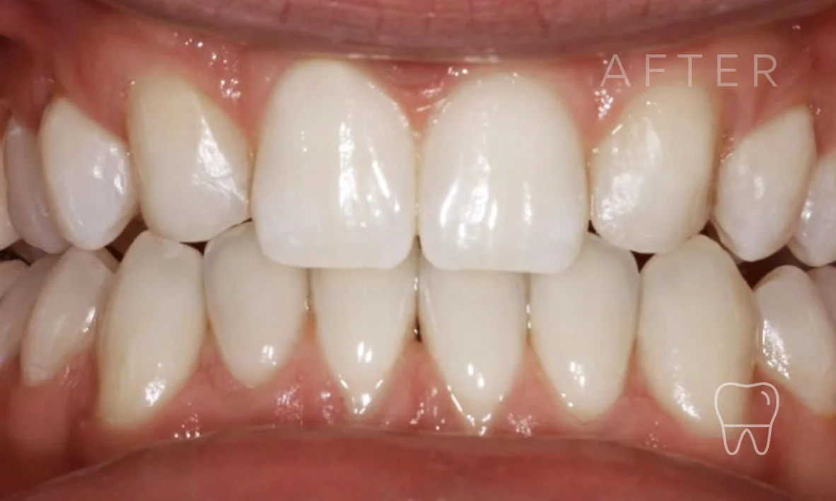 ©-Clear-Braces-Sydney-Patient-Kristoff-After.jpg