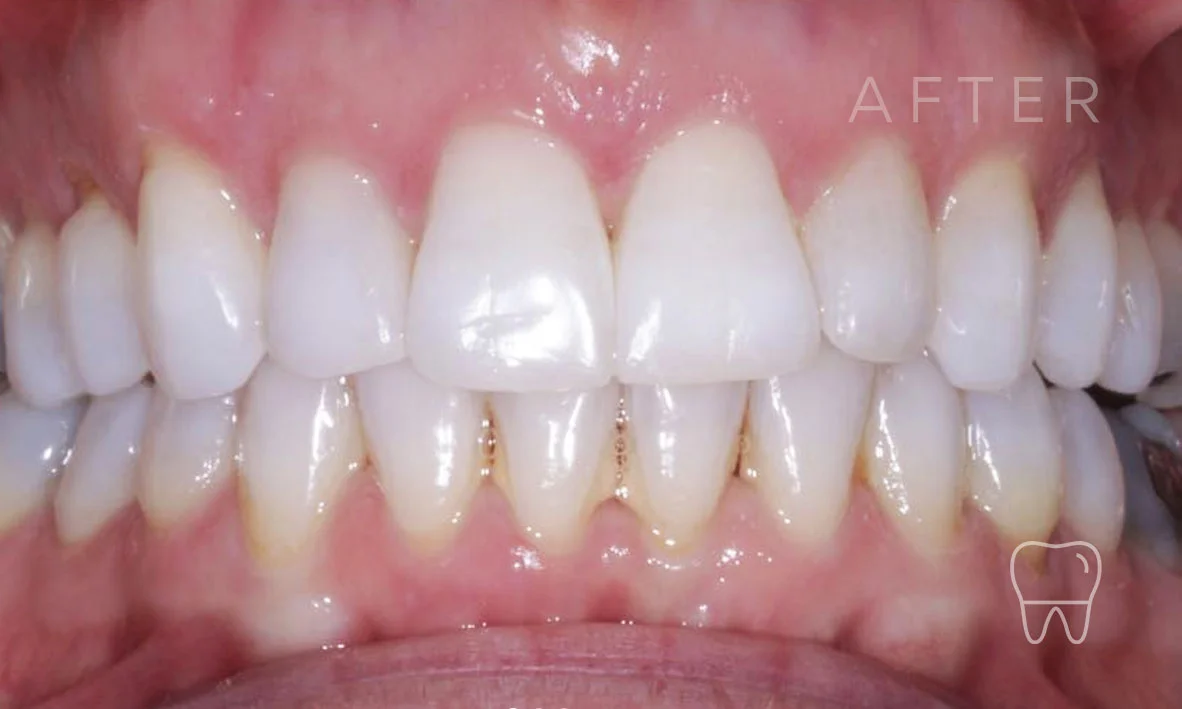 ©-Clear-Braces-Sydney-Patient-Gabriele-After.jpg
