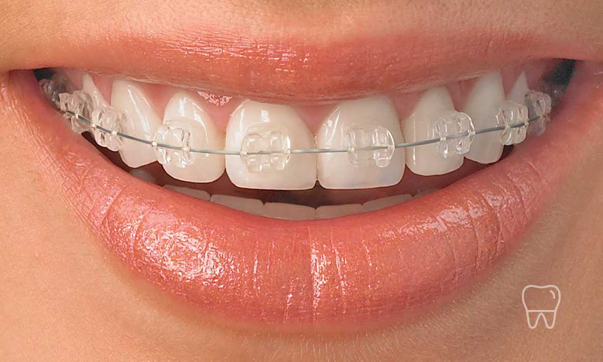 ©-Clear-Braces-Sydney-Dentist-Ceramic-Braces-01.jpg