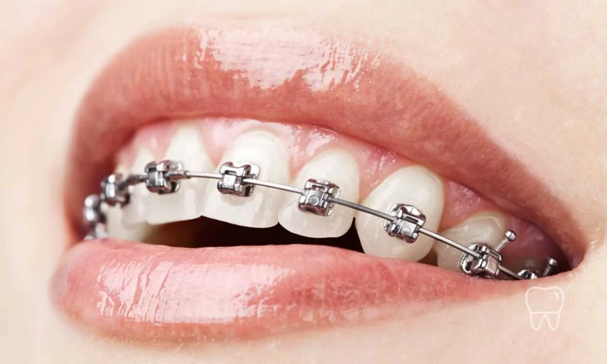 © Clear Braces Sydney Best Dentist Metal Braces.jpg