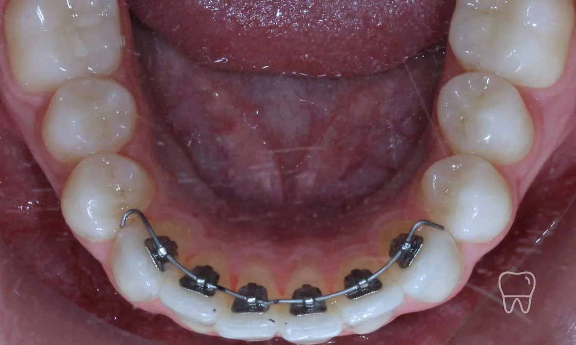 © Clear Braces Sydney Best Dentist Lingual Braces.jpg
