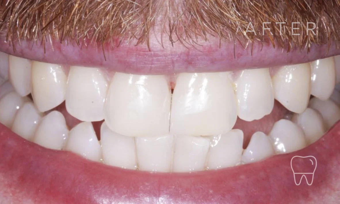 ©-Clear-Braces-Sydney-Patient-Nathaniel-After.jpg