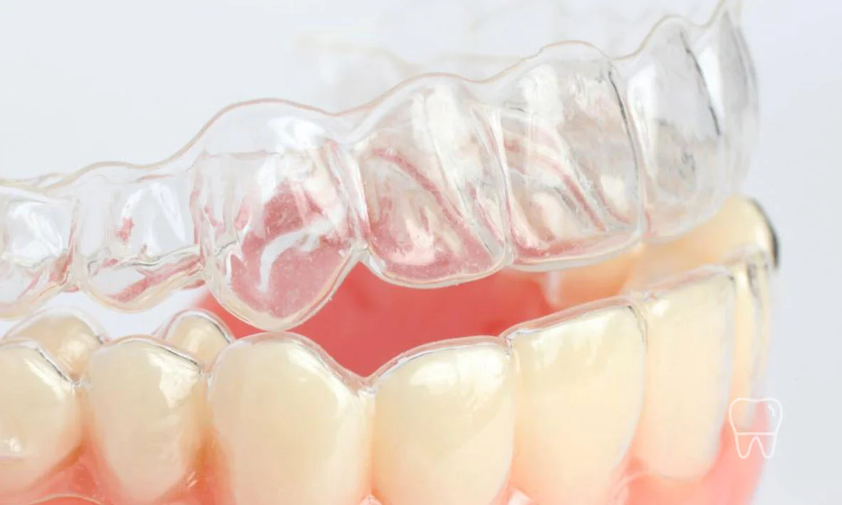 © Clear Braces Dentist Sydney Invisalign Clear Braces 01.jpg