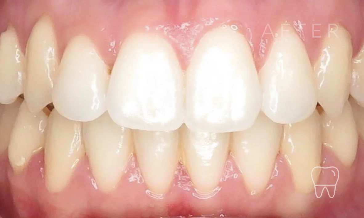 ©-Clear-Braces-Sydney-Patient-Patrice-After.jpg