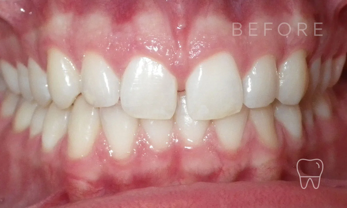 ©-Clear-Braces-Sydney-Patient-Luka-Before.jpg
