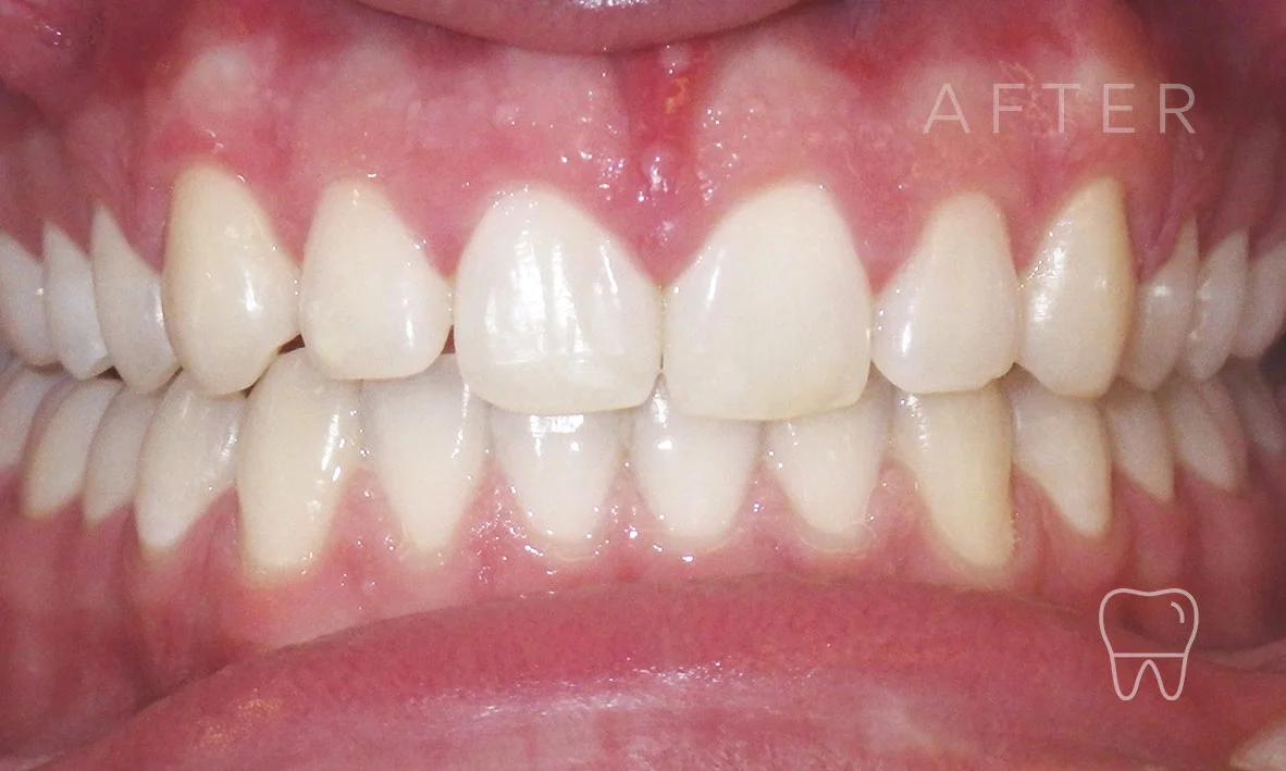 ©-Clear-Braces-Sydney-Patient-Luka-After.jpg