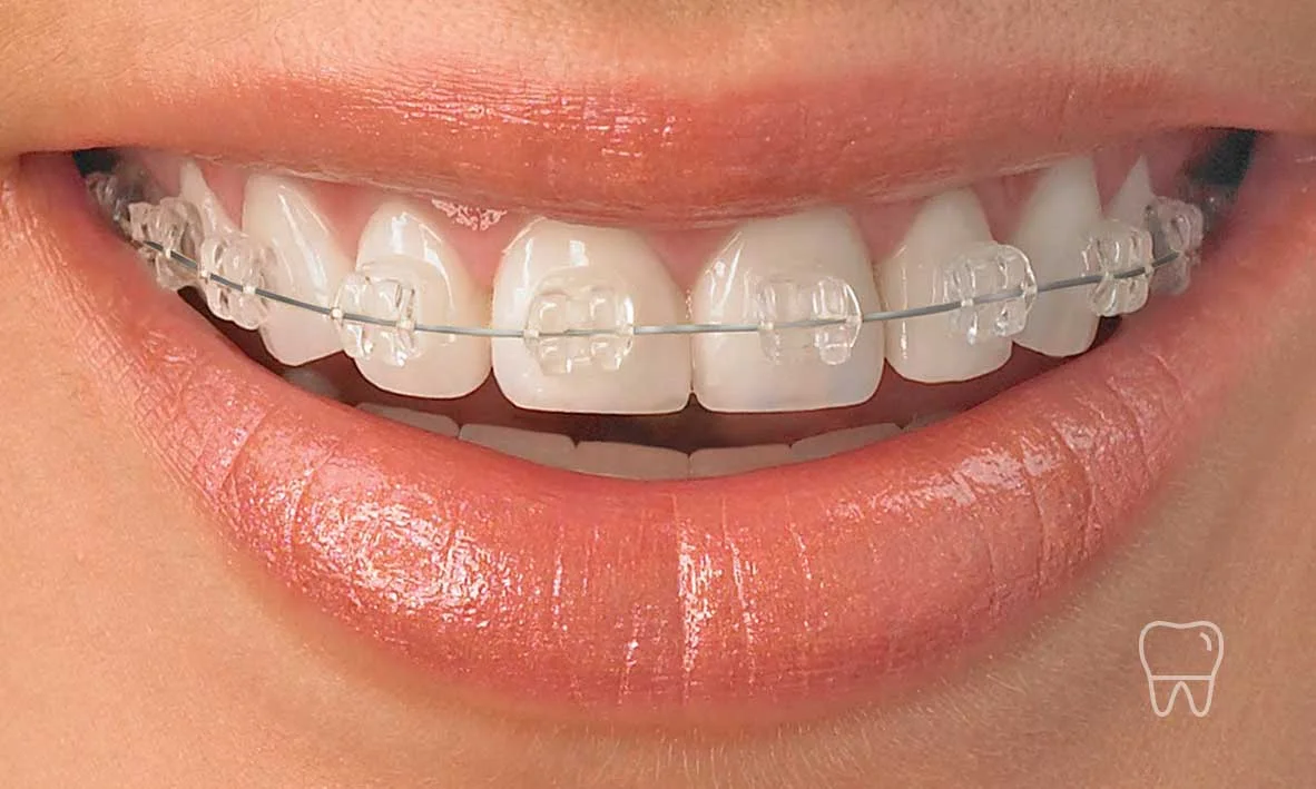 ©-Clear-Braces-Sydney-Dentist-Ceramic-Braces-01.jpg