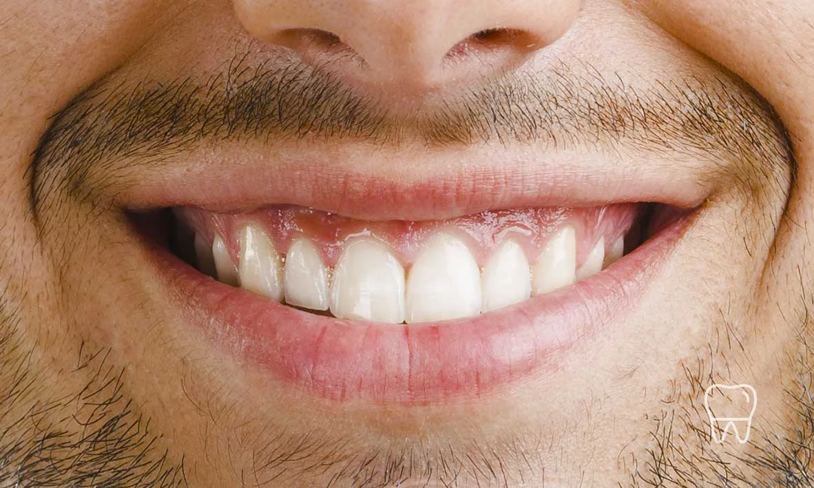 © Clear Braces Sydney Best Dentist Adult Braces.jpg