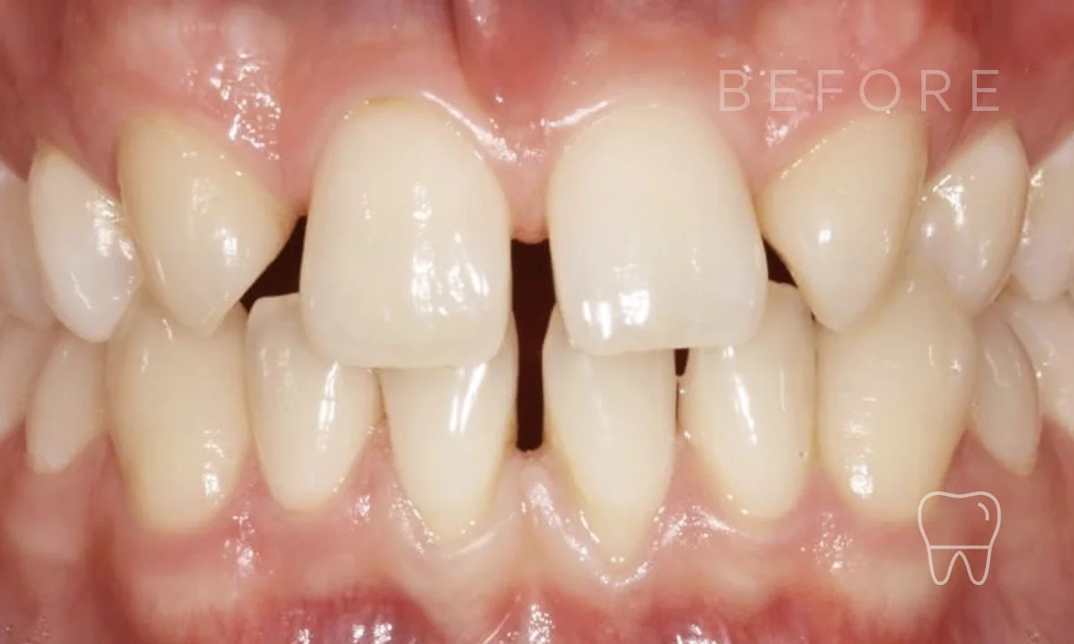©-Clear-Braces-Sydney-Patient-Kristoff-Before.jpg
