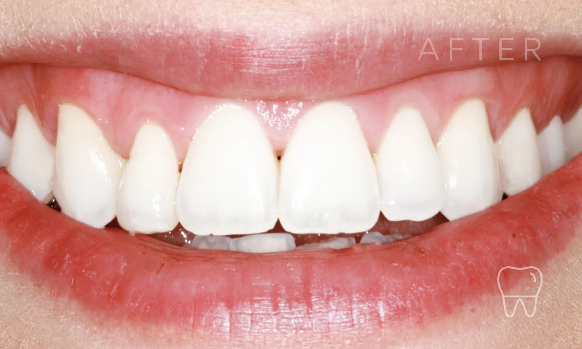 ©-Clear-Braces-Sydney-Patient-Alice-After.jpg