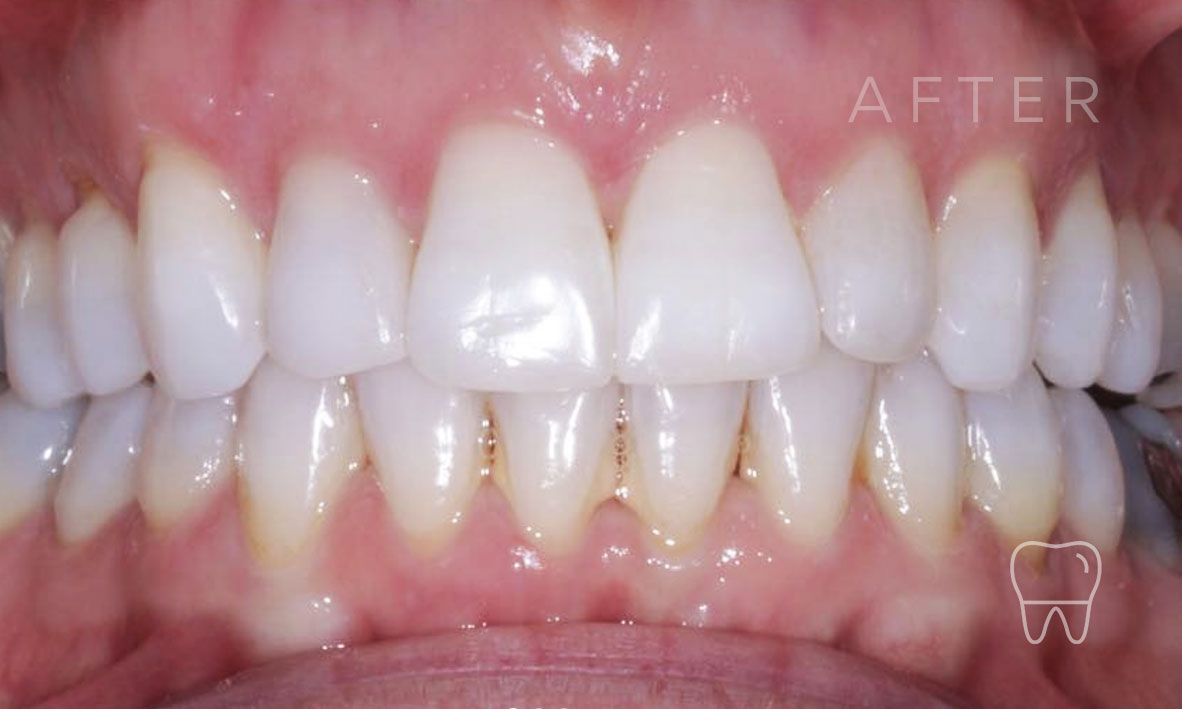 ©-Clear-Braces-Sydney-Patient-Gabriele-After.jpg