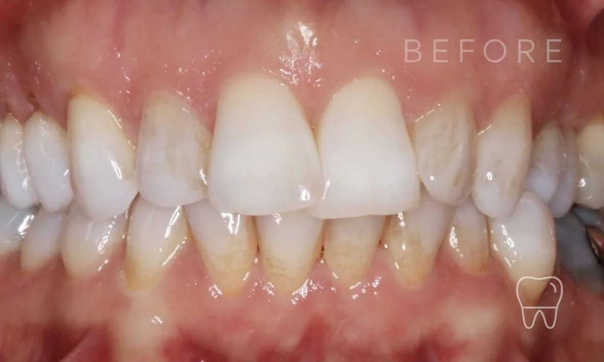 ©-Clear-Braces-Sydney-Patient-Gabriele-Before.jpg