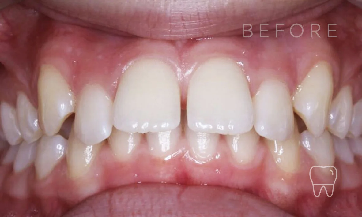 ©-Clear-Braces-Sydney-Patient-Hannah-Before.jpg