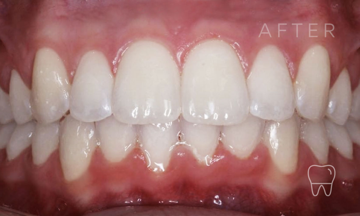 ©-Clear-Braces-Sydney-Patient-Hannah-After.jpg
