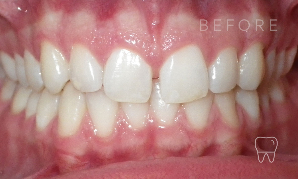 ©-Clear-Braces-Sydney-Patient-Luka-Before.jpg