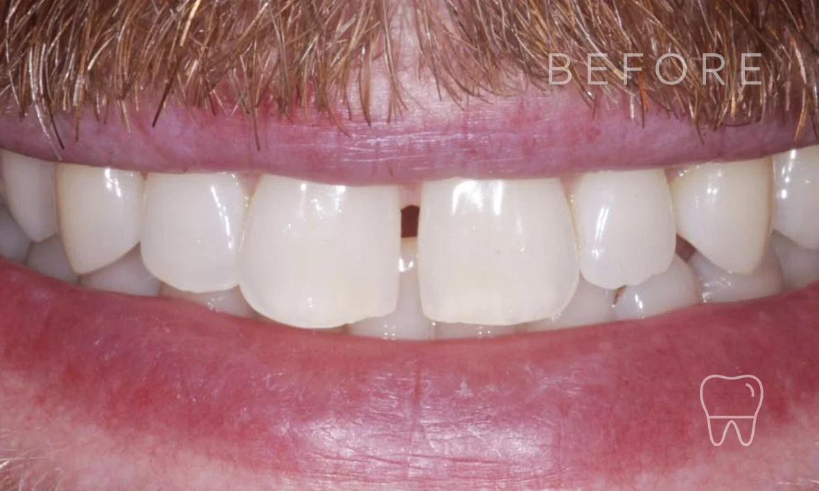 ©-Clear-Braces-Sydney-Patient-Nathaniel-Before.jpg