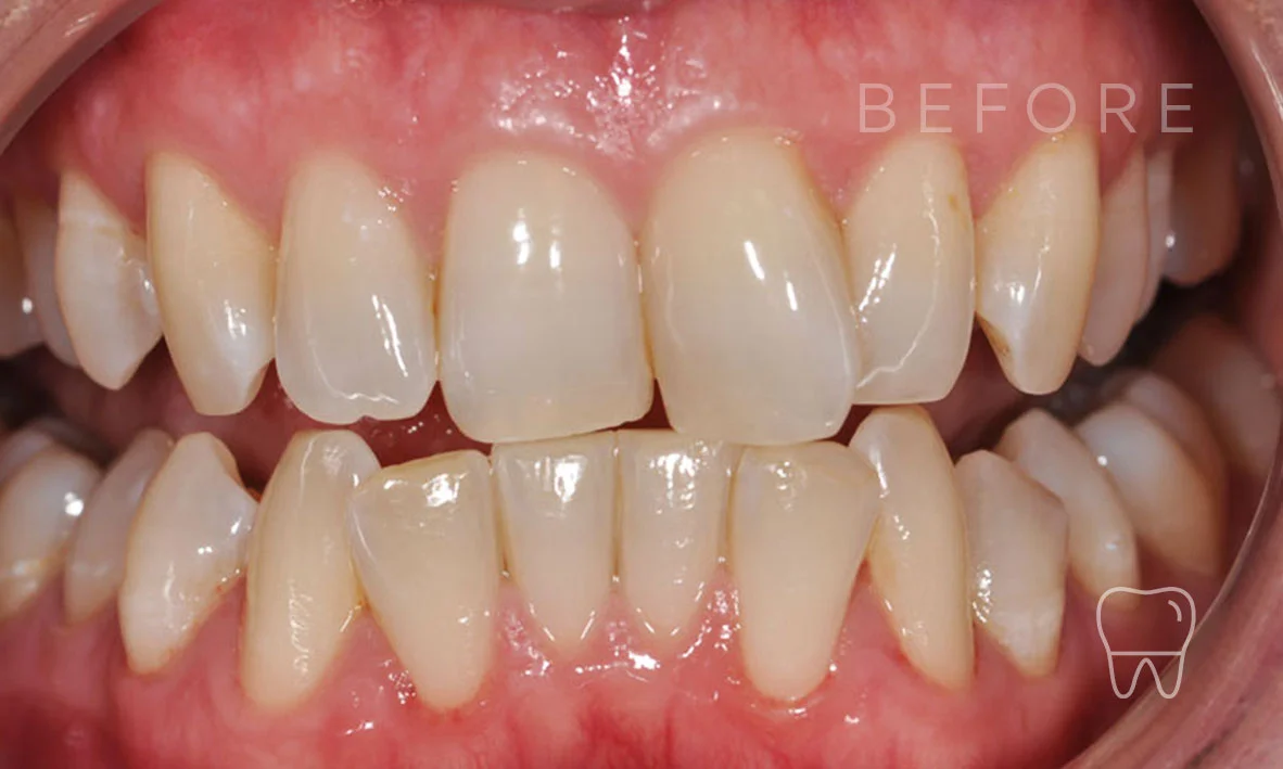 ©-Clear-Braces-Sydney-Patient-Denise-Before.jpg