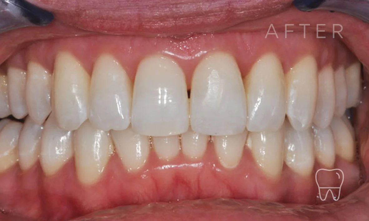©-Clear-Braces-Sydney-Patient-Denise-After.jpg