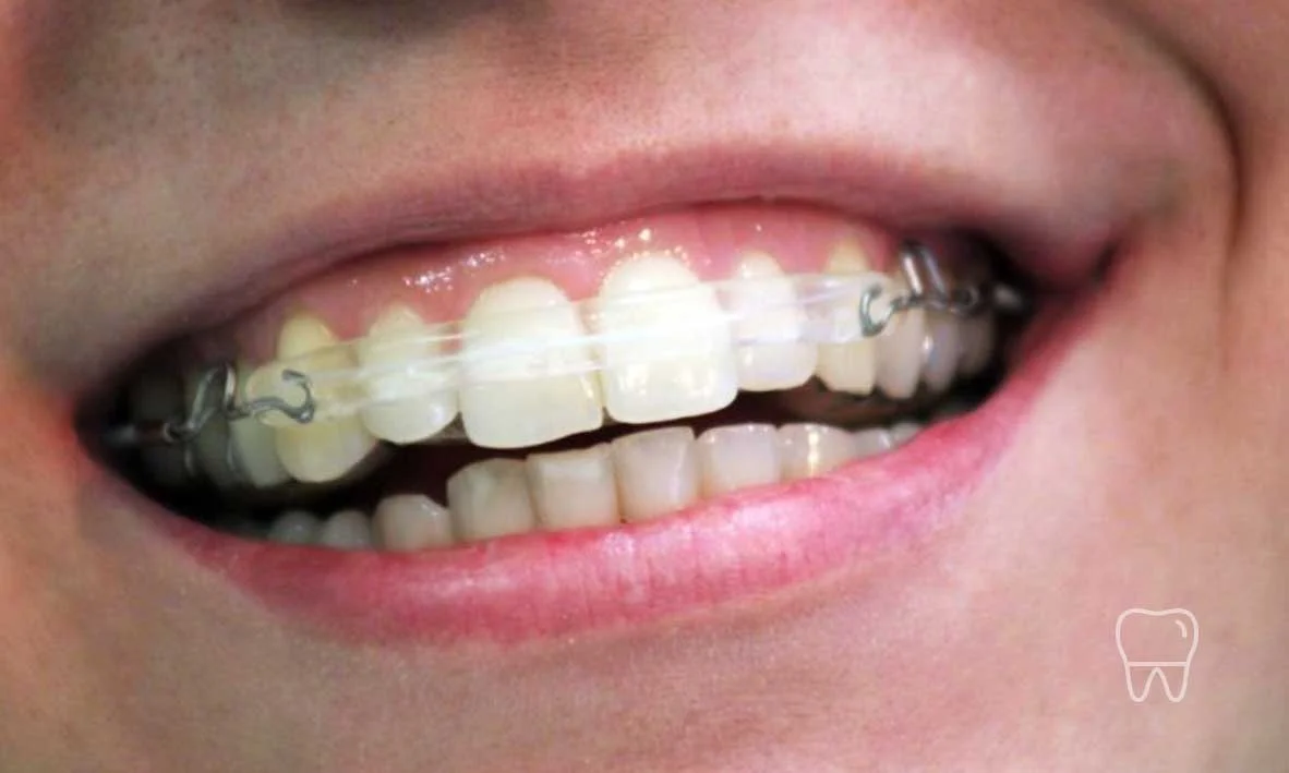 © Clear Braces Sydney Best Dentist Inman Aligners.jpg