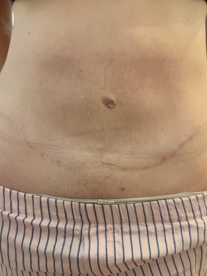 RESULT 🎉🎉🎉 
We love it when a treatment plan exceeds even our highest expectations! 😍

You might recognise this  post from our grid back in April (take a look at images  2 &amp; 3 for the reminder / back-story!). She originally came to us for Lym
