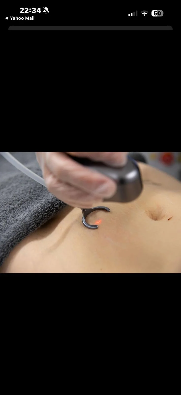 Co2 Fractional Laser Stomach Area