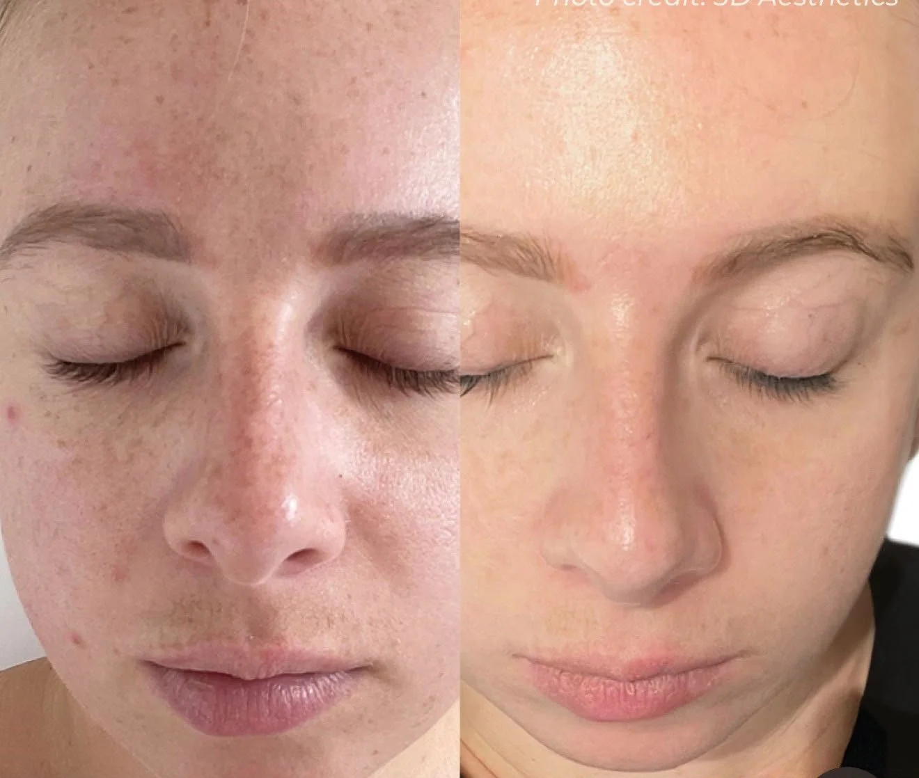 3D Dermaforce and Microneedling Body
