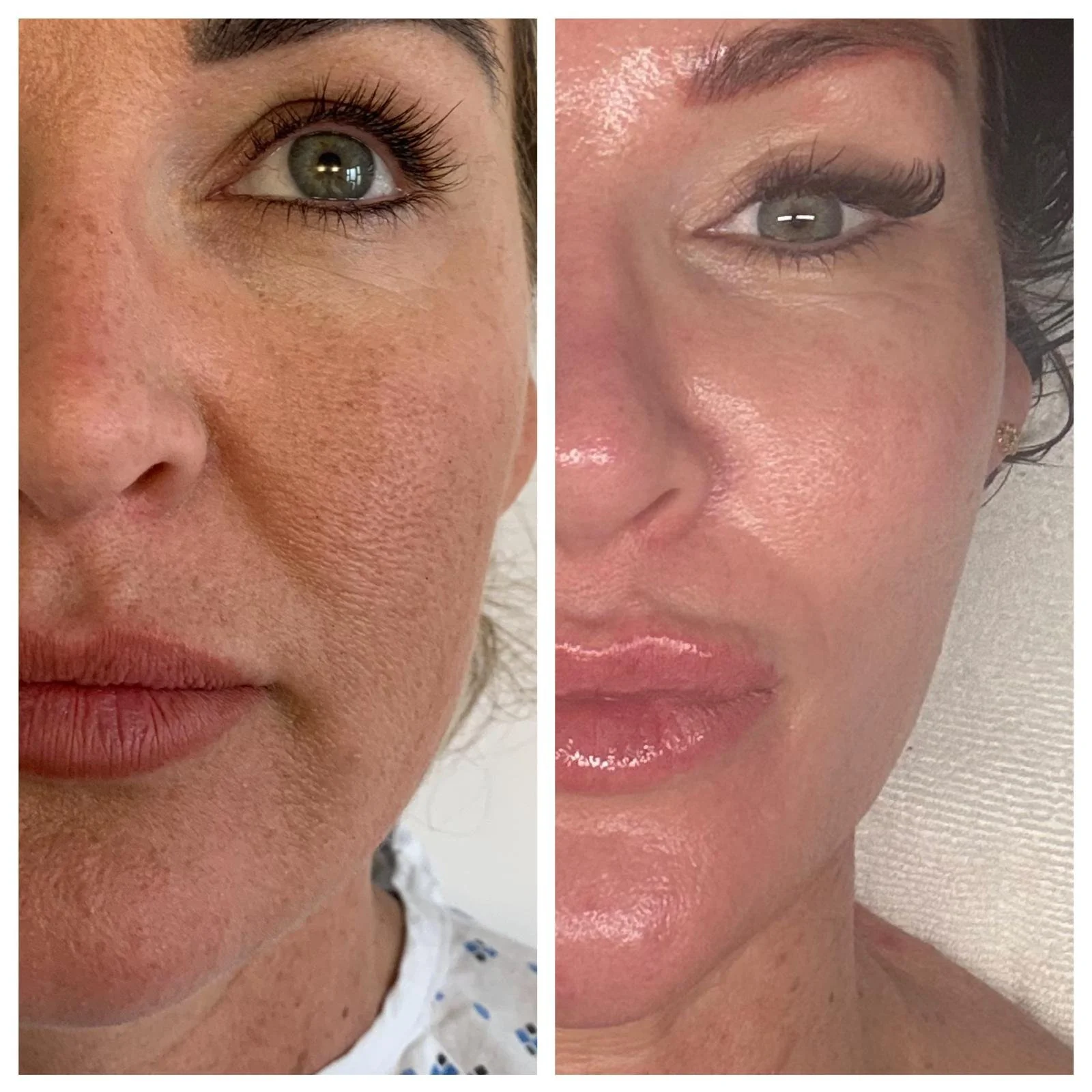 Co2 Fractional Laser Face and Neck
