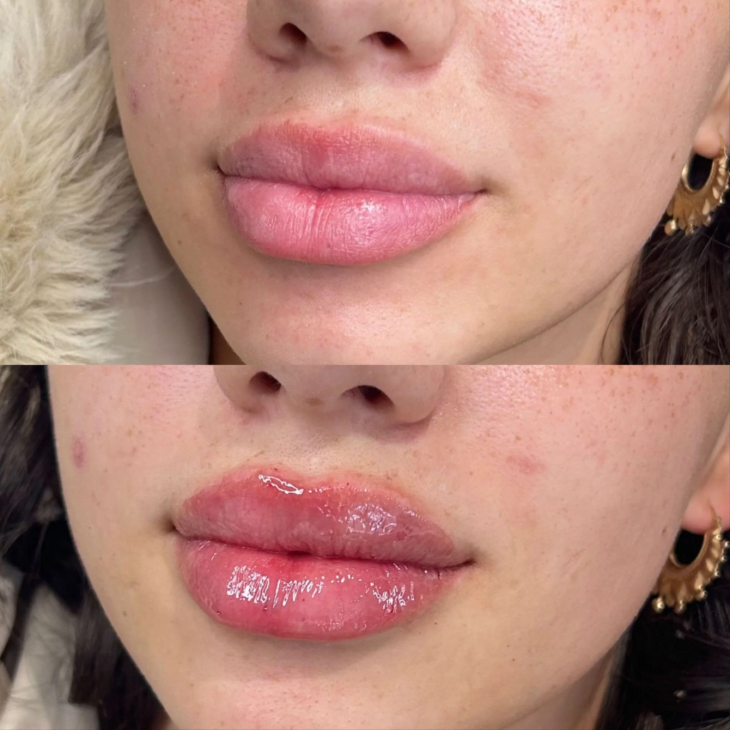 X Lip Filler (Based on 1ml only)