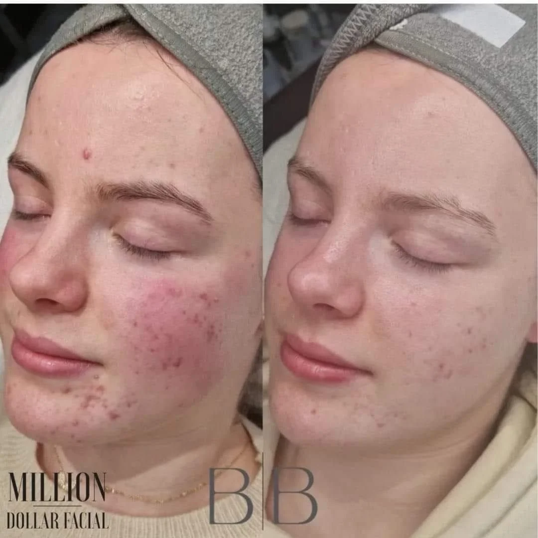 Million Dollar Immaculate Peel