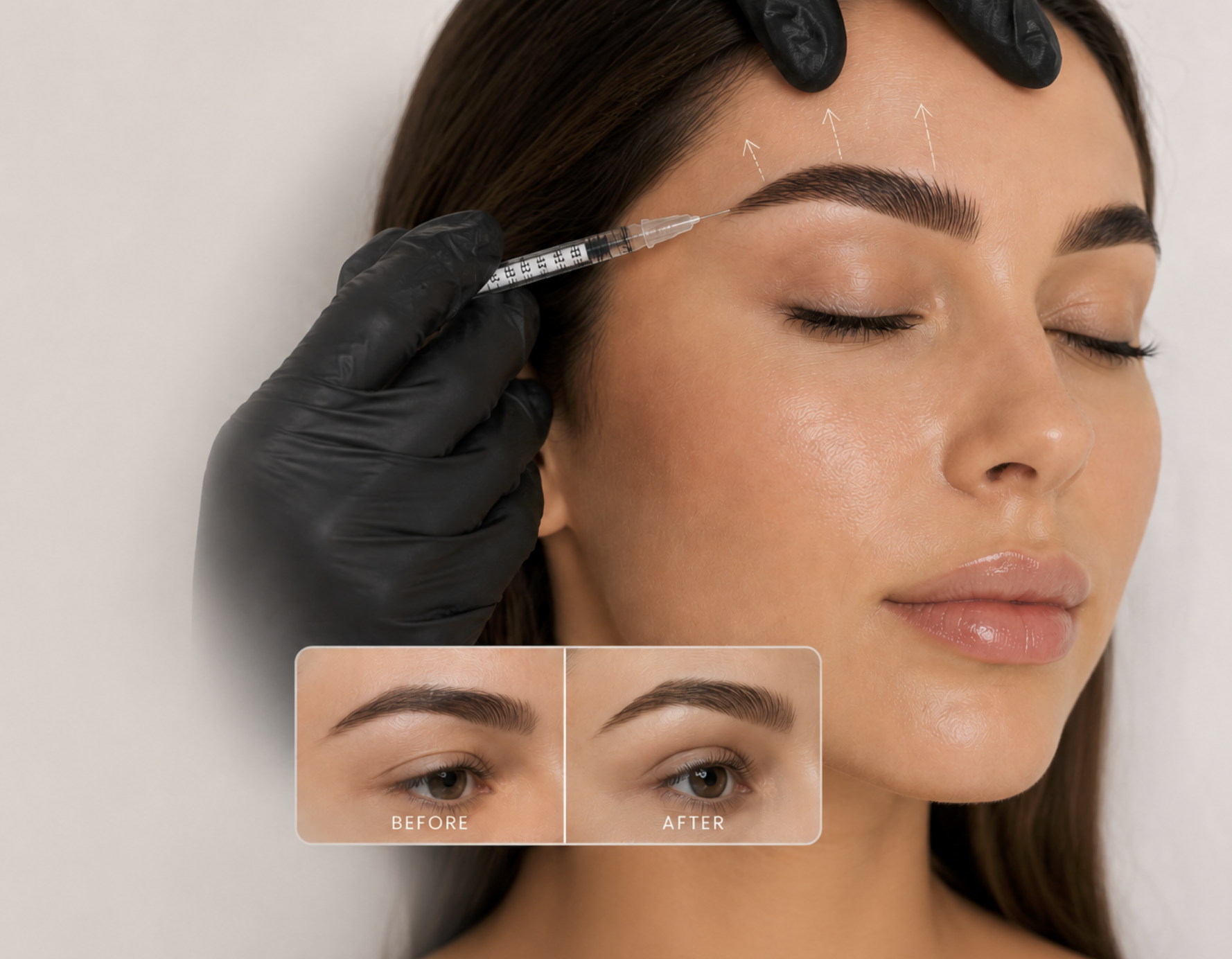 Brow Lift (Model)