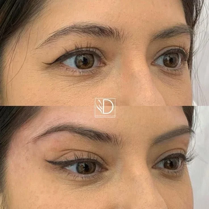 Brow Lift