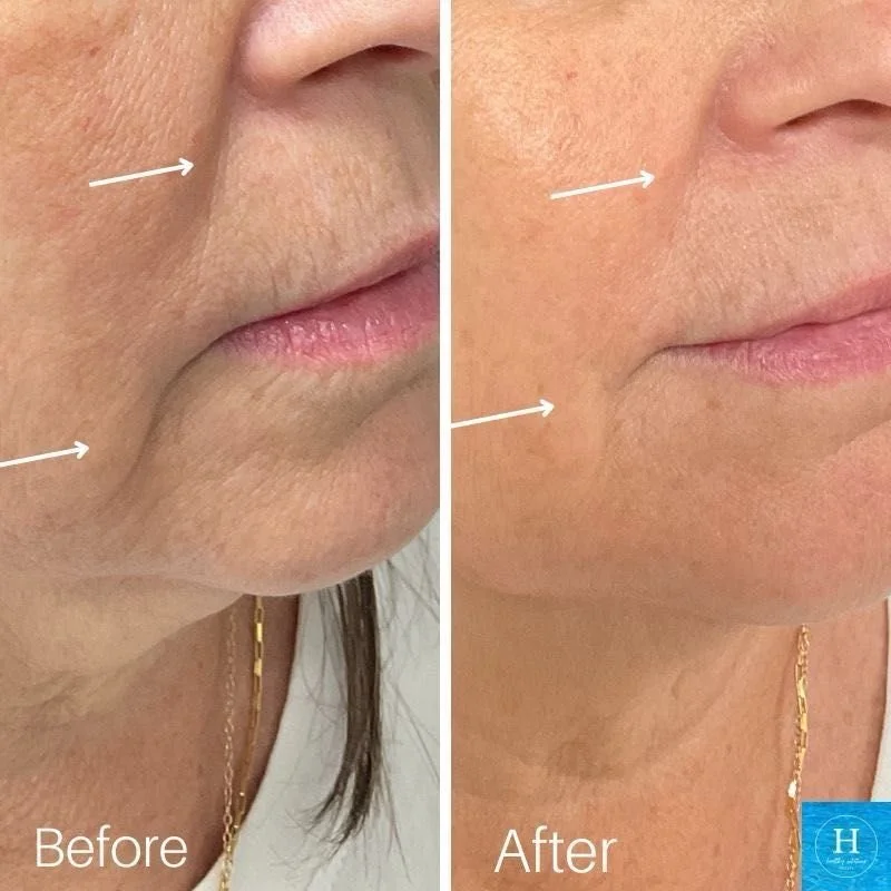 X Nasial Labial Fold (Smile Lines) (1ml only)