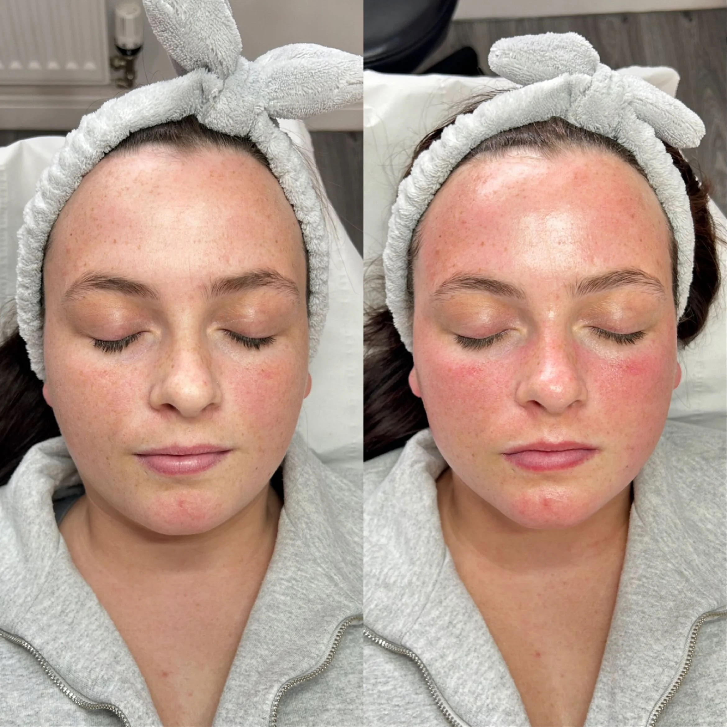 Million Dollar Microneedling Facial