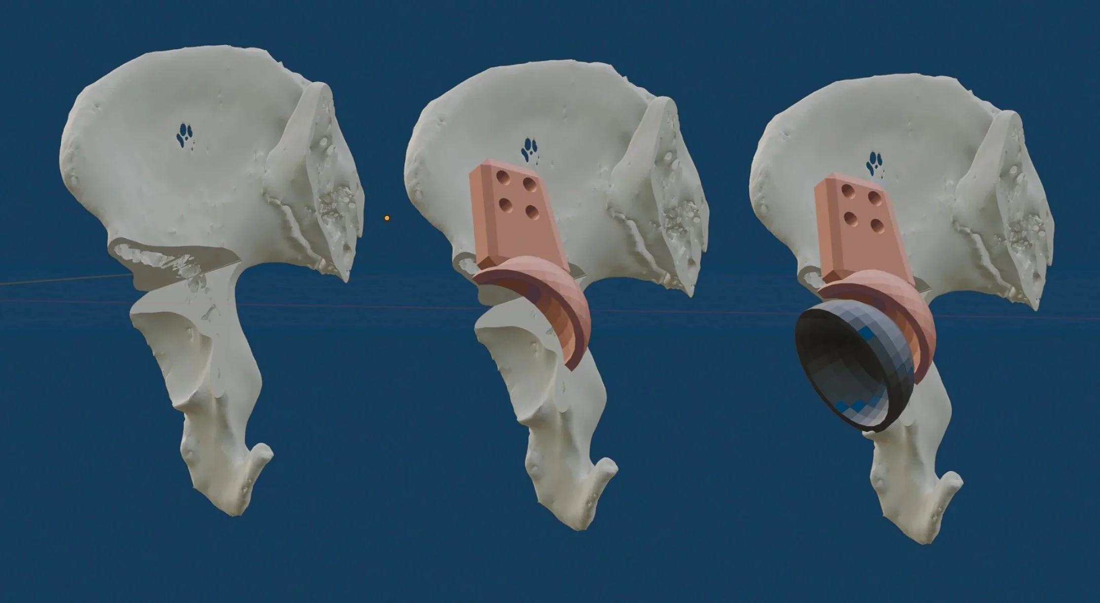 Plan e impresión 3D en condrosarcoma de pelvis