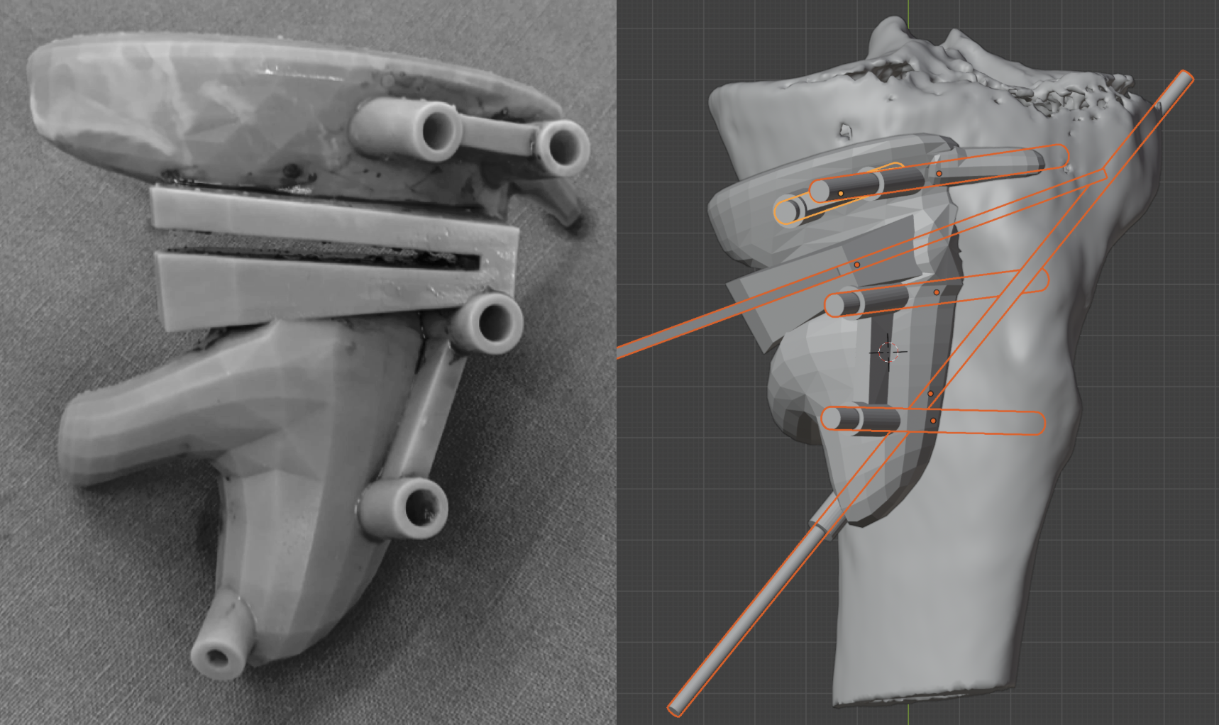 PSI en osteotomía de tibia