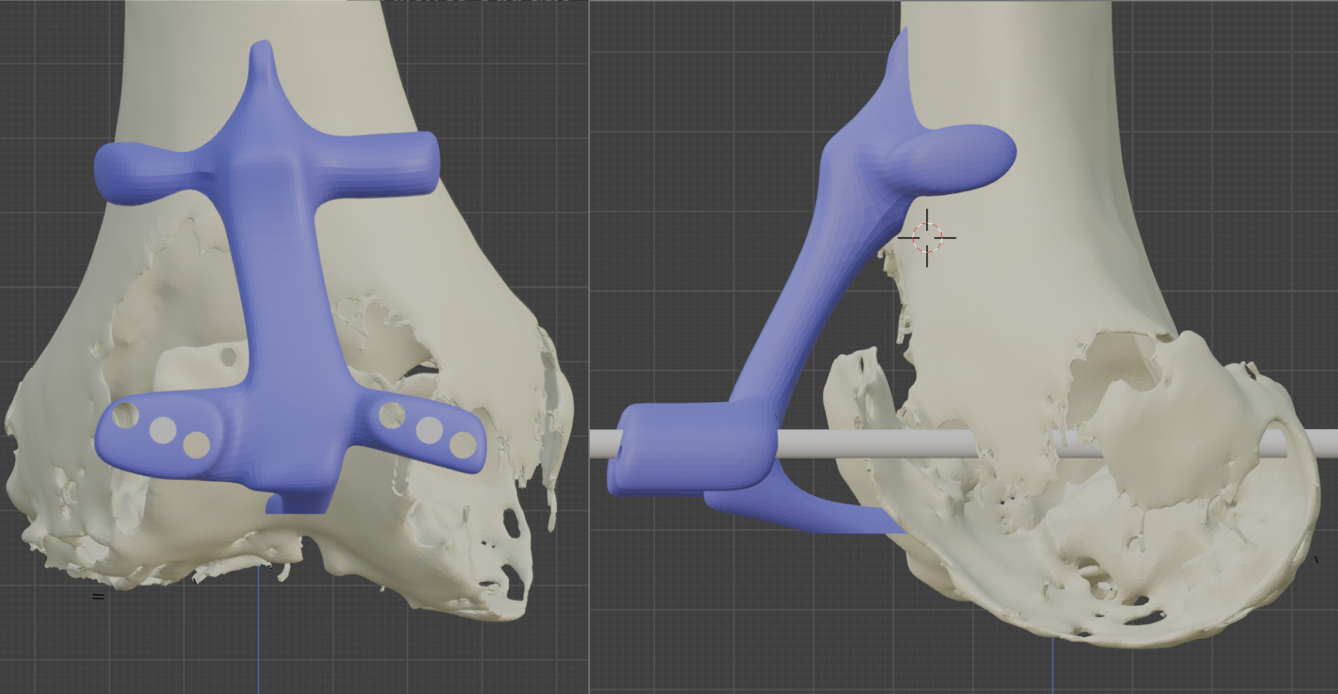 PSI en prótesis de rodilla