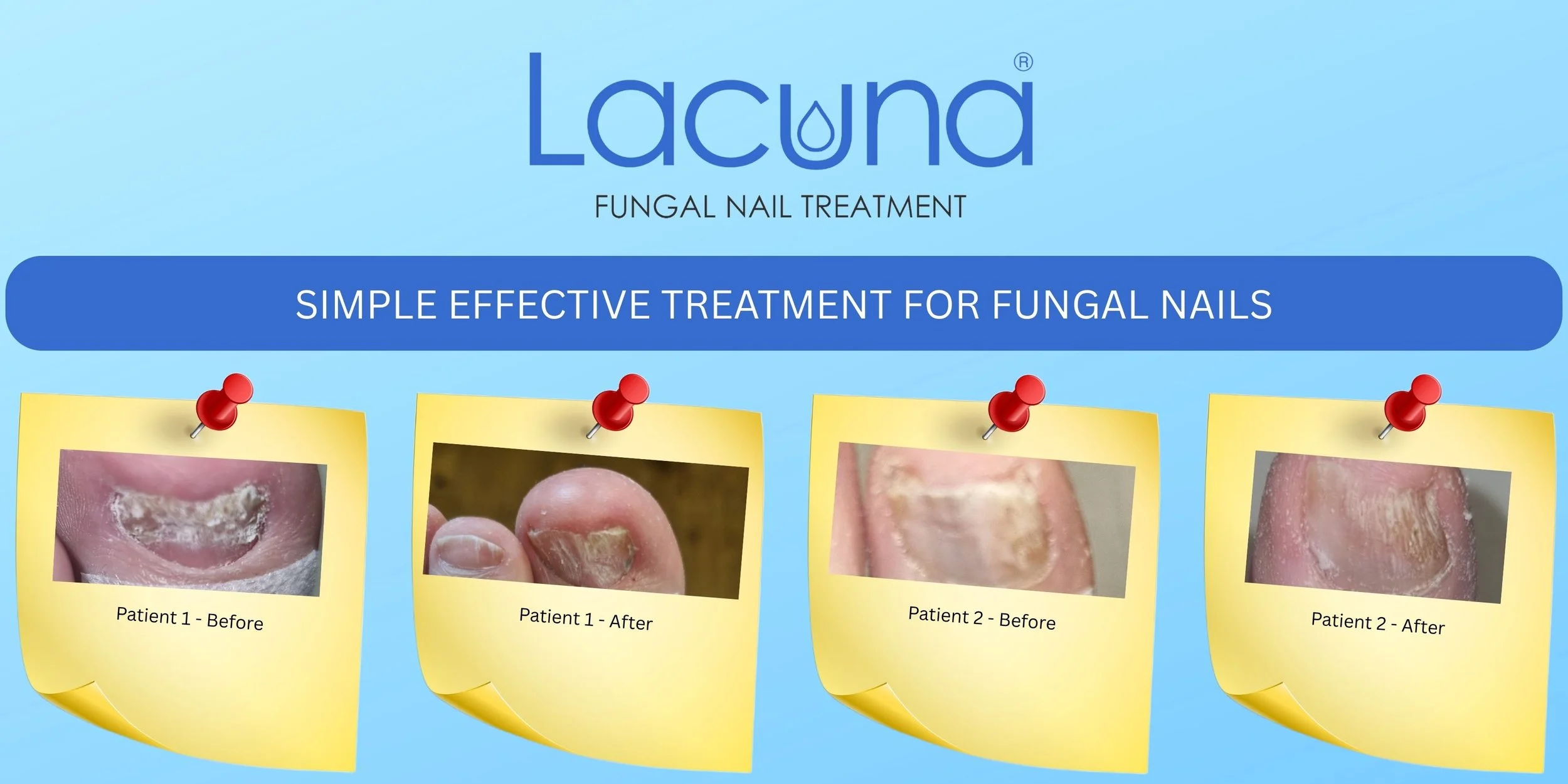 Lacuna Method treatment being applied to a fungal toenail