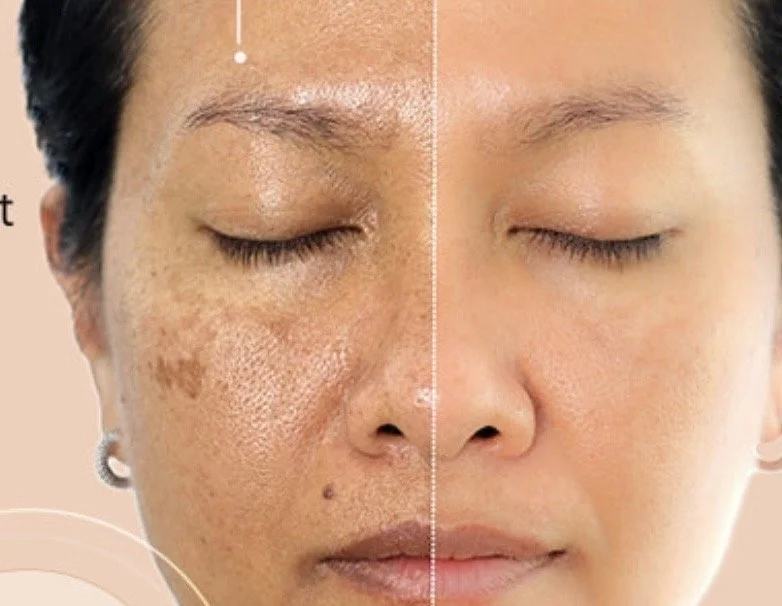 Pigment Correction